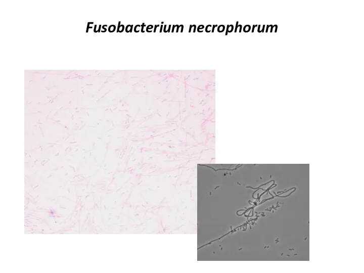 Fusobacterium necrophorum