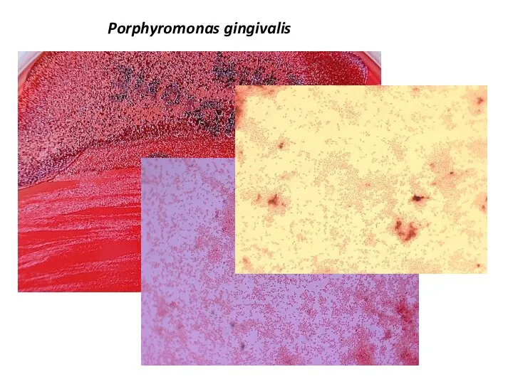 Porphyromonas gingivalis