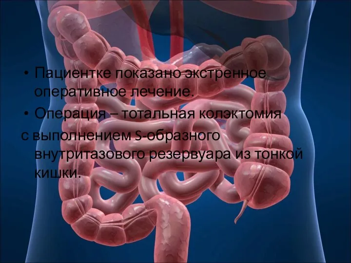 Пациентке показано экстренное оперативное лечение. Операция – тотальная колэктомия с выполнением S-образного