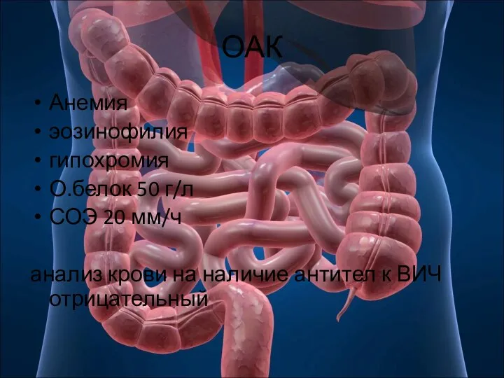 ОАК Анемия эозинофилия гипохромия О.белок 50 г/л СОЭ 20 мм/ч анализ крови
