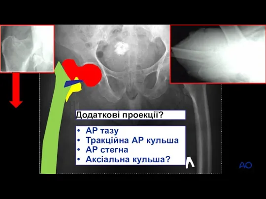 Додаткові проекції? AP тазу Тракційна АР кульша АР стегна Аксіальна кульша?