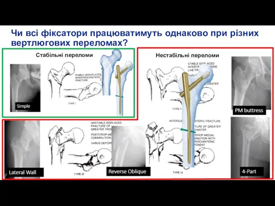 Чи всі фіксатори працюватимуть однаково при різних вертлюгових переломах? Стабільні переломи Нестабільні переломи