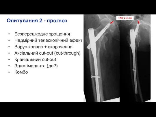 Опитування 2 - прогноз Безперешкодне зрощення Надмірний телескопічний ефект Варус-колапс + вкорочення