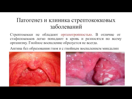 Патогенез и клиника стрептококковых заболеваний Стрептококки не обладают органотропностью. В отличие от