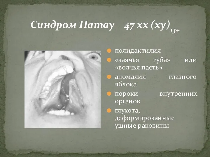 Синдром Патау 47 хх (ху)13+ полидактилия «заячья губа» или «волчья пасть» аномалия