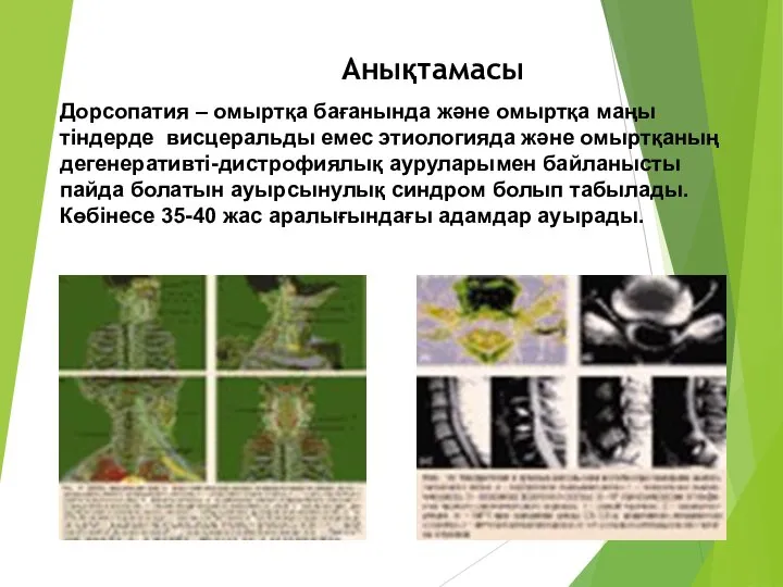 Анықтамасы Дорсопатия – омыртқа бағанында және омыртқа маңы тіндерде висцеральды емес этиологияда