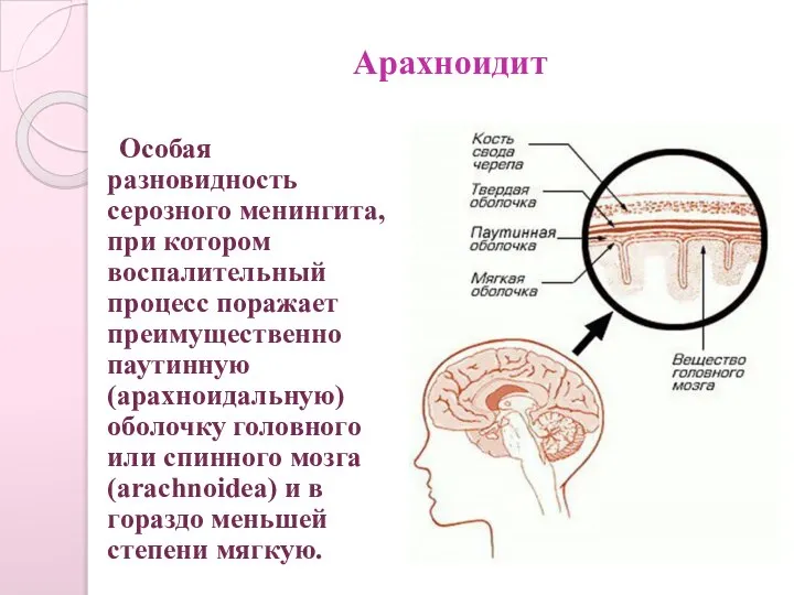 Арахноидит Особая разновидность серозного менингита, при котором воспалительный процесс поражает преимущественно паутинную