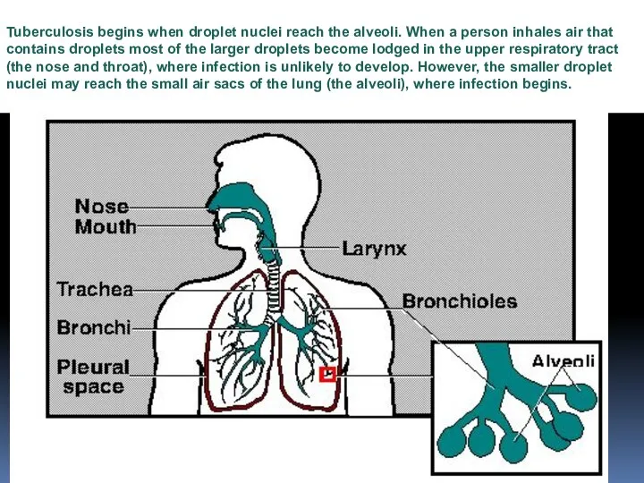 Tuberculosis begins when droplet nuclei reach the alveoli. When a person inhales