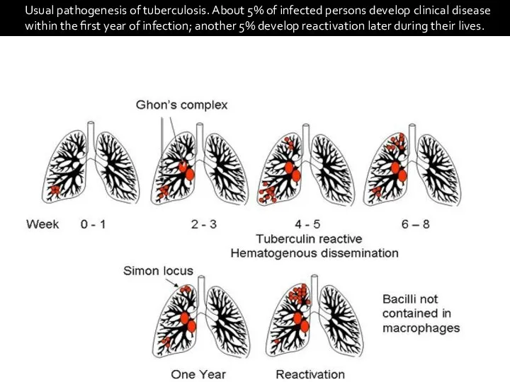 Usual pathogenesis of tuberculosis. About 5% of infected persons develop clinical disease