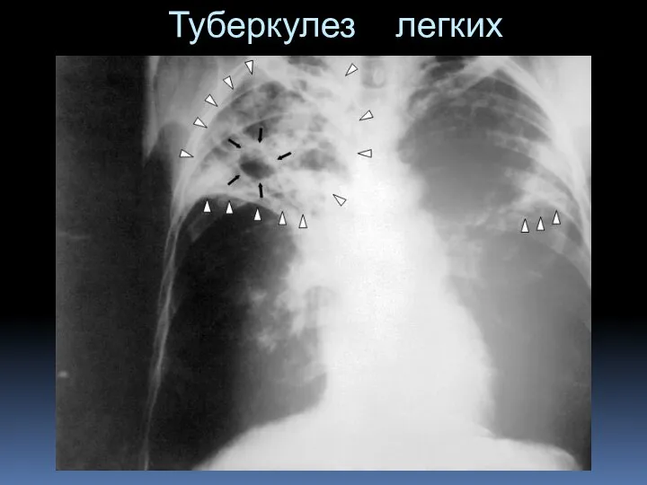 Туберкулез легких