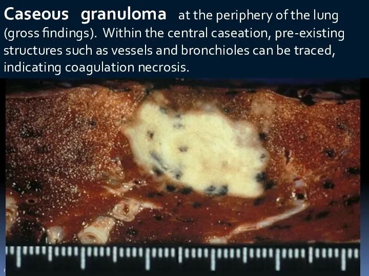 http://info.fujita-hu.ac.jp/~tsutsumi/case/case076.htm Caseous granuloma at the periphery of the lung (gross findings). Within