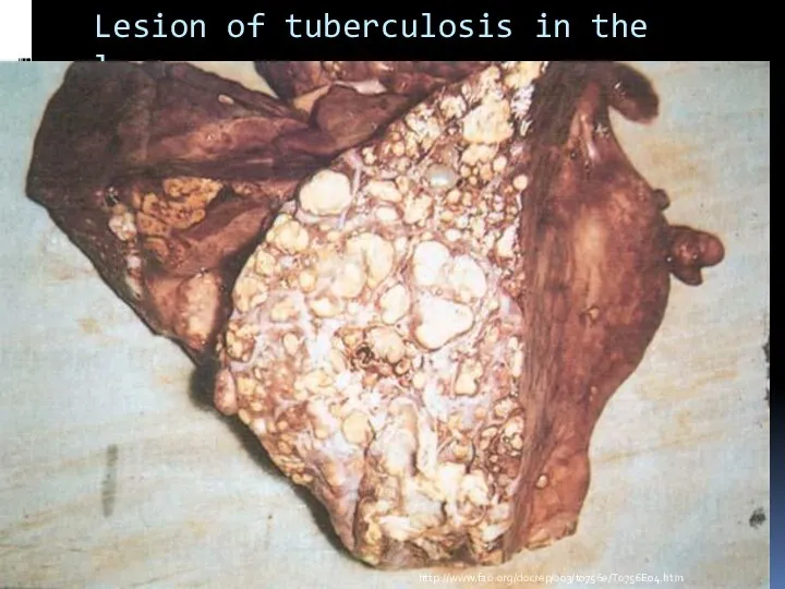 Lesion of tuberculosis in the lungs http://www.fao.org/docrep/003/t0756e/T0756E04.htm