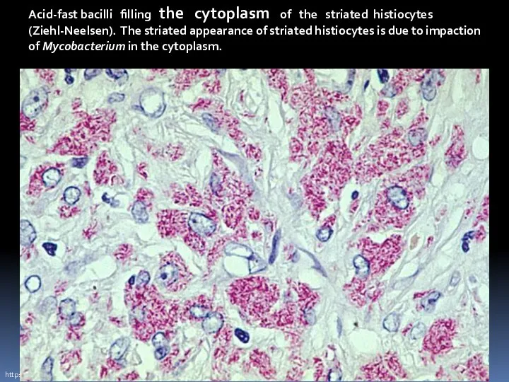 http://info.fujita-hu.ac.jp/~tsutsumi/case/case077.htm Acid-fast bacilli filling the cytoplasm of the striated histiocytes (Ziehl-Neelsen). The