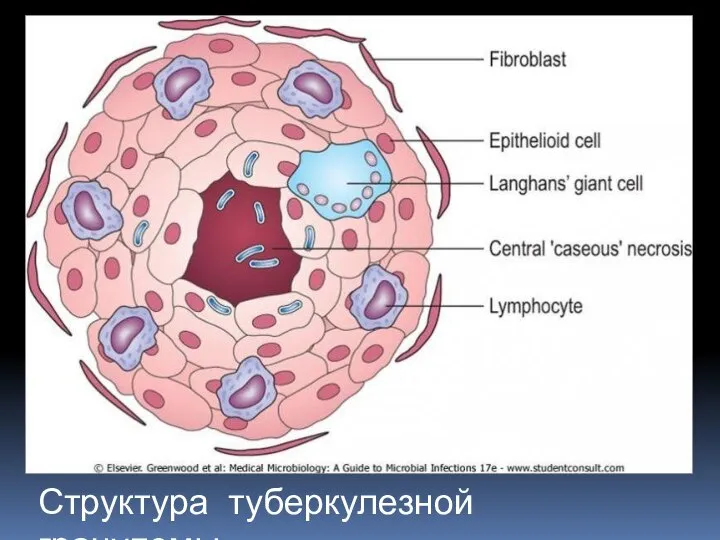 Структура туберкулезной гранулемы