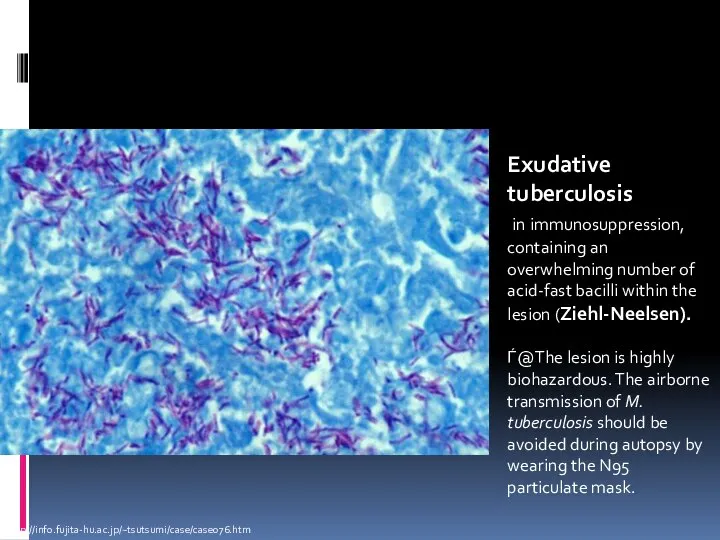 http://info.fujita-hu.ac.jp/~tsutsumi/case/case076.htm Exudative tuberculosis in immunosuppression, containing an overwhelming number of acid-fast bacilli