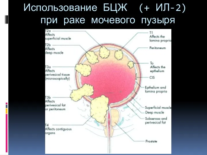 Использование БЦЖ (+ ИЛ-2) при раке мочевого пузыря