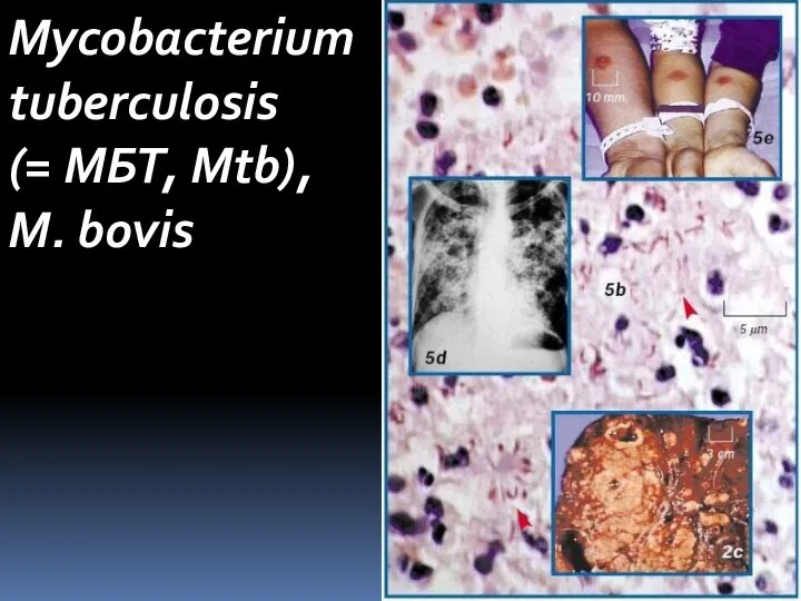Mycobacterium tuberculosis (= МБТ, Mtb), M. bovis