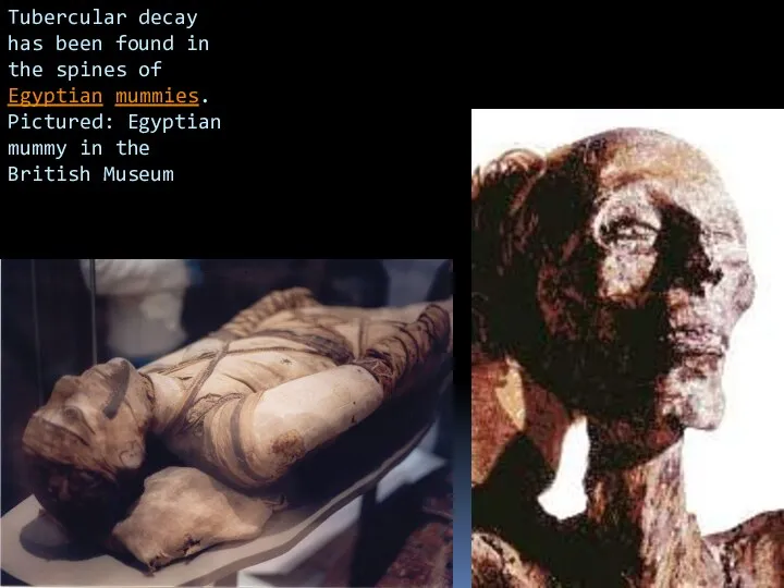Tubercular decay has been found in the spines of Egyptian mummies. Pictured: