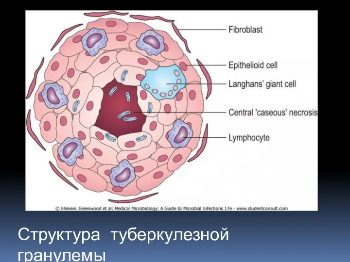 Структура туберкулезной гранулемы