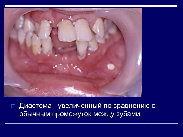 Диастема - увеличенный по сравнению с обычным промежуток между зубами