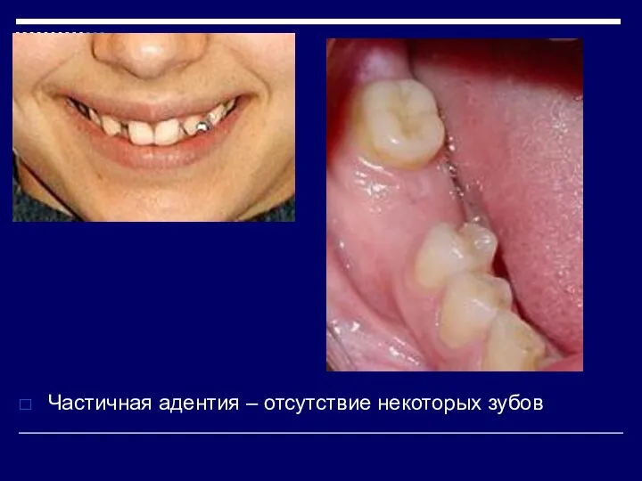 Частичная адентия – отсутствие некоторых зубов