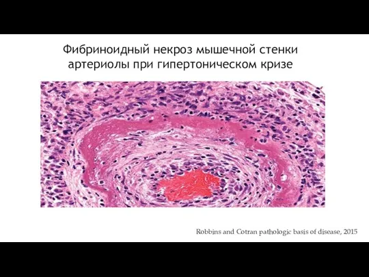 Robbins and Cotran pathologic basis of disease, 2015 Фибриноидный некроз мышечной стенки артериолы при гипертоническом кризе