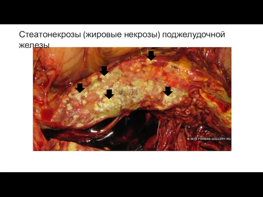 Стеатонекрозы (жировые некрозы) поджелудочной железы