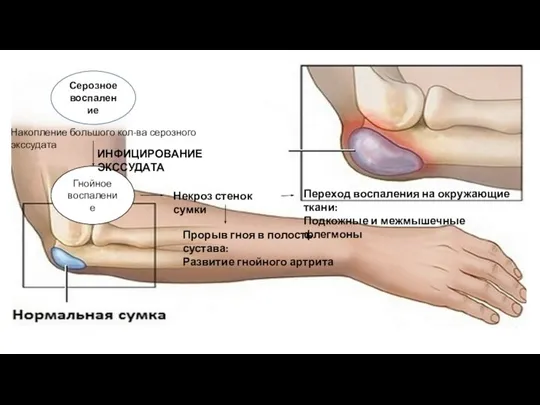 Серозное воспаление Накопление большого кол-ва серозного экссудата Гнойное воспаление ИНФИЦИРОВАНИЕ ЭКССУДАТА Некроз