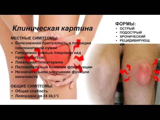 Клиническая картина МЕСТНЫЕ СИМПТОМЫ: Болезненная припухлость в проекции синовиальной сумки Гиперемия кожных