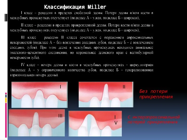 Классификация Miller I III II IV Без потери прикрепления С интеропроксимальной потерей прикрепления