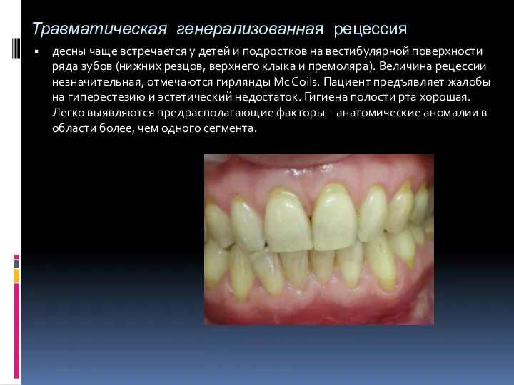 Травматическая генерализованная рецессия десны чаще встречается у детей и подростков на вестибулярной