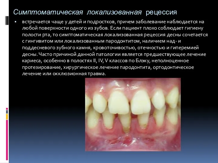 Симптоматическая локализованная рецессия встречается чаще у детей и подростков, причем заболевание наблюдается