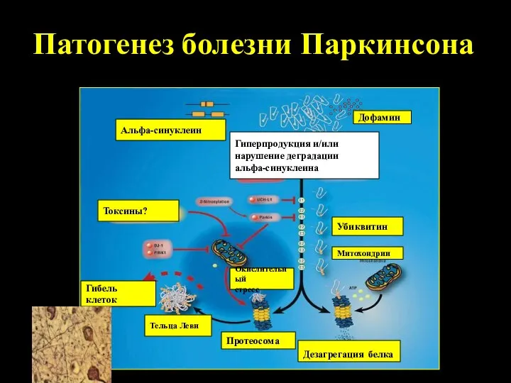 Патогенез болезни Паркинсона Окислительный стресс Тельца Леви Токсины? Гиперпродукция и/или нарушение деградации