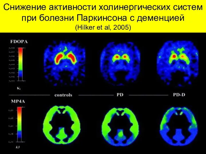 Снижение активности холинергических систем при болезни Паркинсона с деменцией (Hilker et al, 2005)