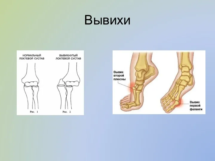 Вывихи