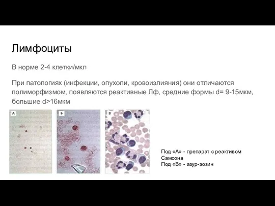 Лимфоциты В норме 2-4 клетки/мкл При патологиях (инфекции, опухоли, кровоизлияния) они отличаются