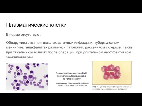 Плазматические клетки В норме отсутствуют. Обнаруживаются при тяжелых затяжных инфекциях: туберкулезном менингите,