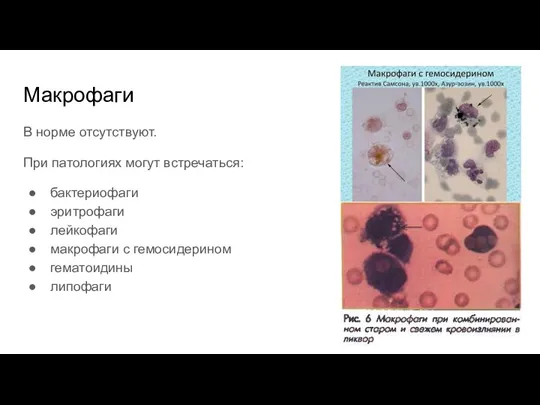 Макрофаги В норме отсутствуют. При патологиях могут встречаться: бактериофаги эритрофаги лейкофаги макрофаги с гемосидерином гематоидины липофаги