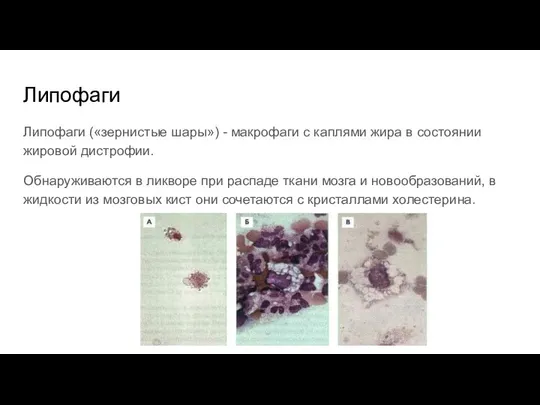 Липофаги Липофаги («зернистые шары») - макрофаги с каплями жира в состоянии жировой