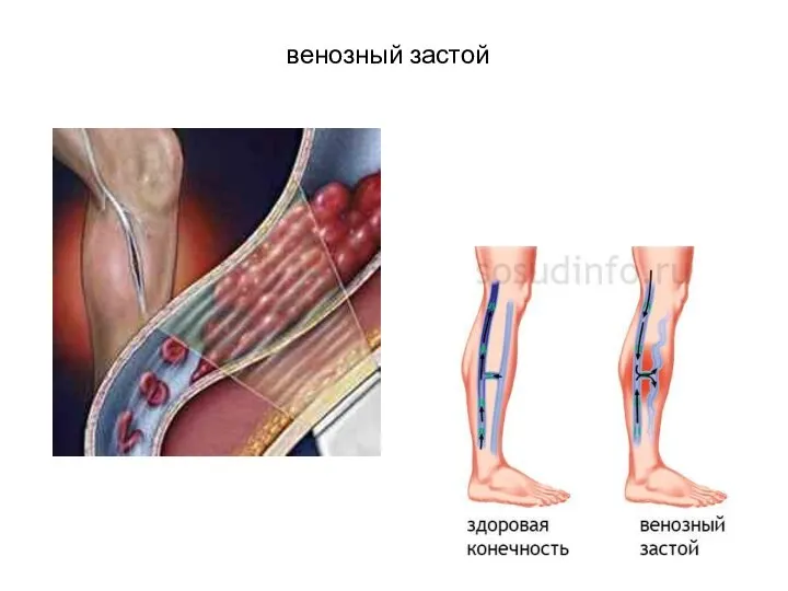 венозный застой