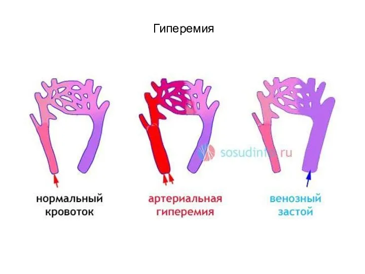 Гиперемия