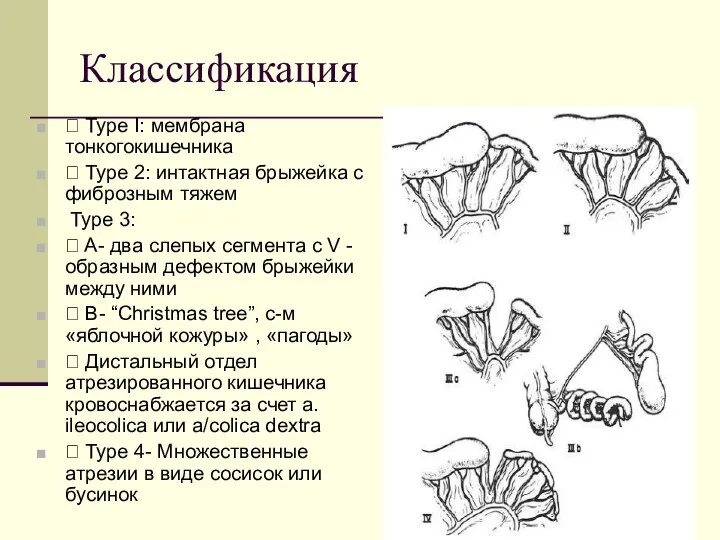 Классификация  Type I: мембрана тонкогокишечника  Type 2: интактная брыжейка с