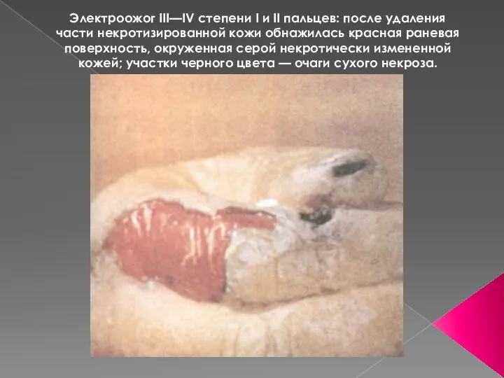 Электроожог III—IV степени I и II пальцев: после удаления части некротизированной кожи