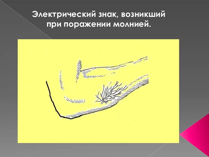 Электрический знак, возникший при поражении молнией.