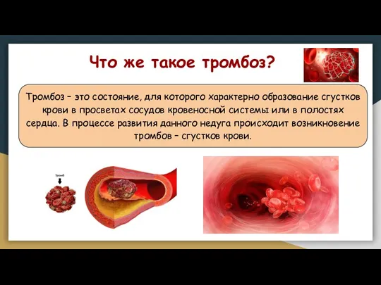 Что же такое тромбоз? Тромбоз – это состояние, для которого характерно образование