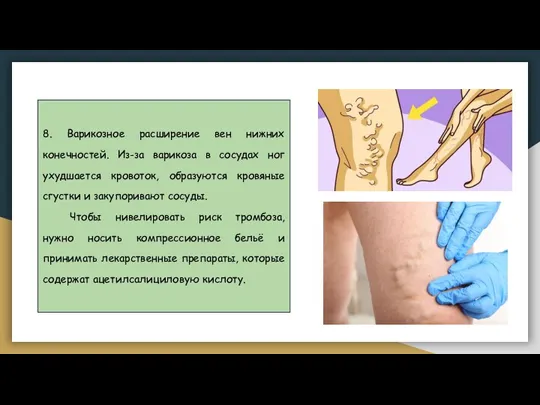 8. Варикозное расширение вен нижних конечностей. Из-за варикоза в сосудах ног ухудшается