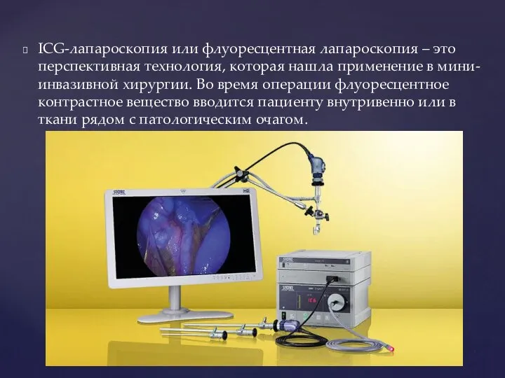 ICG-лапароскопия или флуоресцентная лапароскопия – это перспективная технология, которая нашла применение в