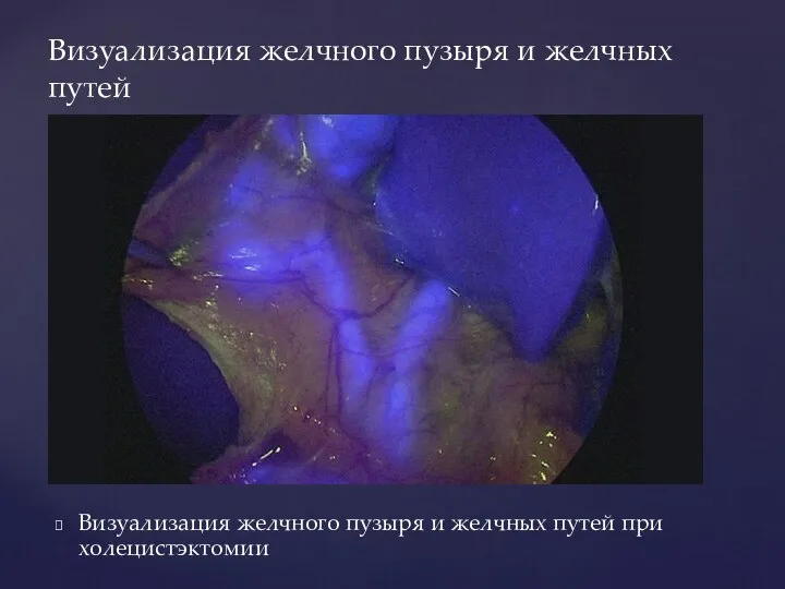 Визуализация желчного пузыря и желчных путей при холецистэктомии Визуализация желчного пузыря и желчных путей