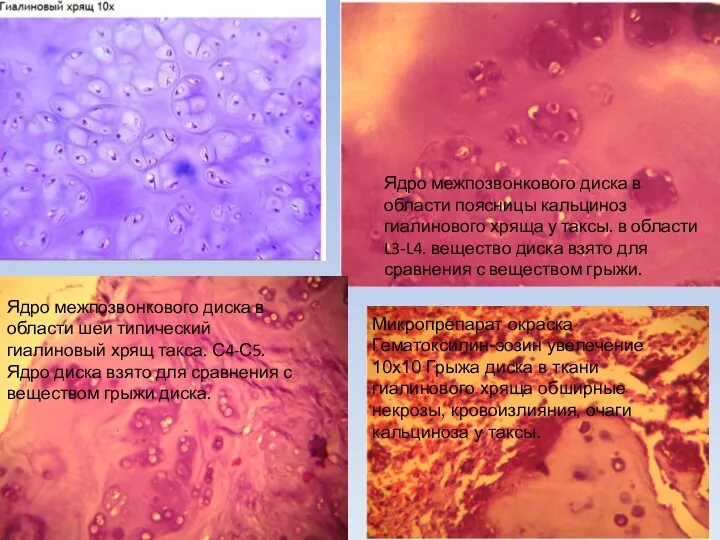 Микропрепарат окраска Гематоксилин-эозин увелечение 10х10 Грыжа диска в ткани гиалинового хряща обширные