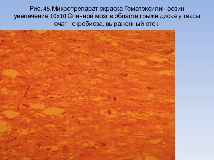 Рис. 45.Микропрепарат окраска Гематоксилин-эозин увелечение 10х10 Спинной мозг в области грыжи диска
